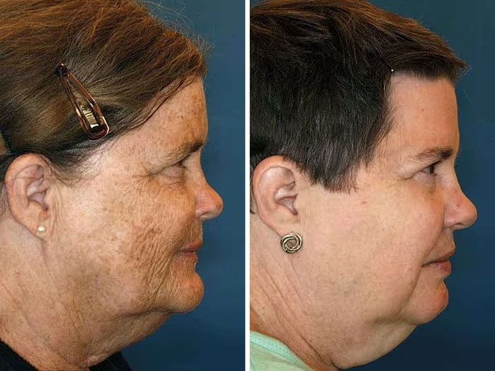 Twins study highlighting impact of divorce and diet on the face; two women in profile with different expressions. Twins study highlighting impact of divorce and diet on the face; two women in profile with different expressions.