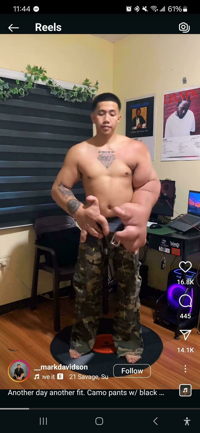 Shirtless man with massively swollen right arm and hand standing in a room wearing camo pants, medical pics