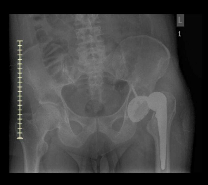 Pelvic X-ray showing right hip prosthesis and pelvic bones, medical pics clinical radiograph