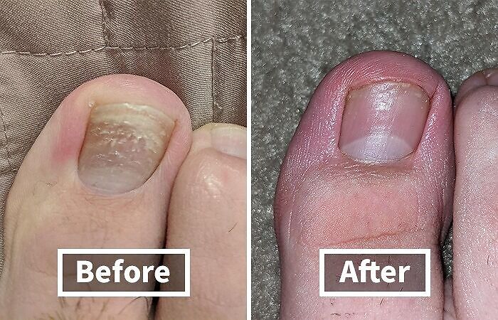 Toe nail improvement before-and-after, showcasing visible transformation.