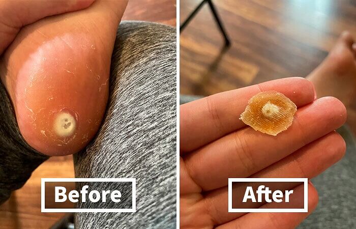 Before-and-after images showing foot treatment results with a removed callus.