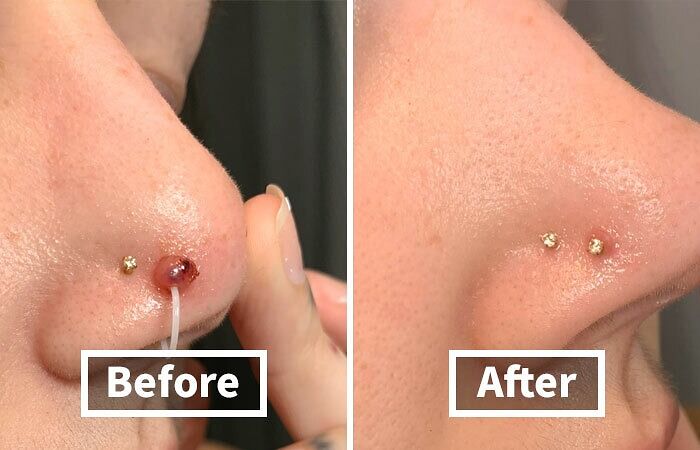 Before-and-after of a healed nose piercing, left side with irritation and the right side showing improvement.