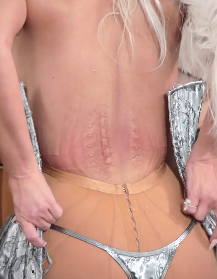 Close-up showing the effects of an ultra-tight Met Gala corset on skin. Close-up showing the effects of an ultra-tight Met Gala corset on skin.