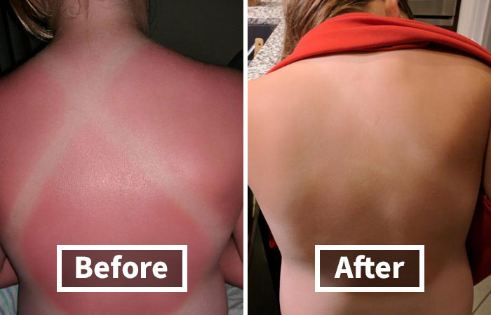 Before-and-after photo showing skin treatment results on a person's back.