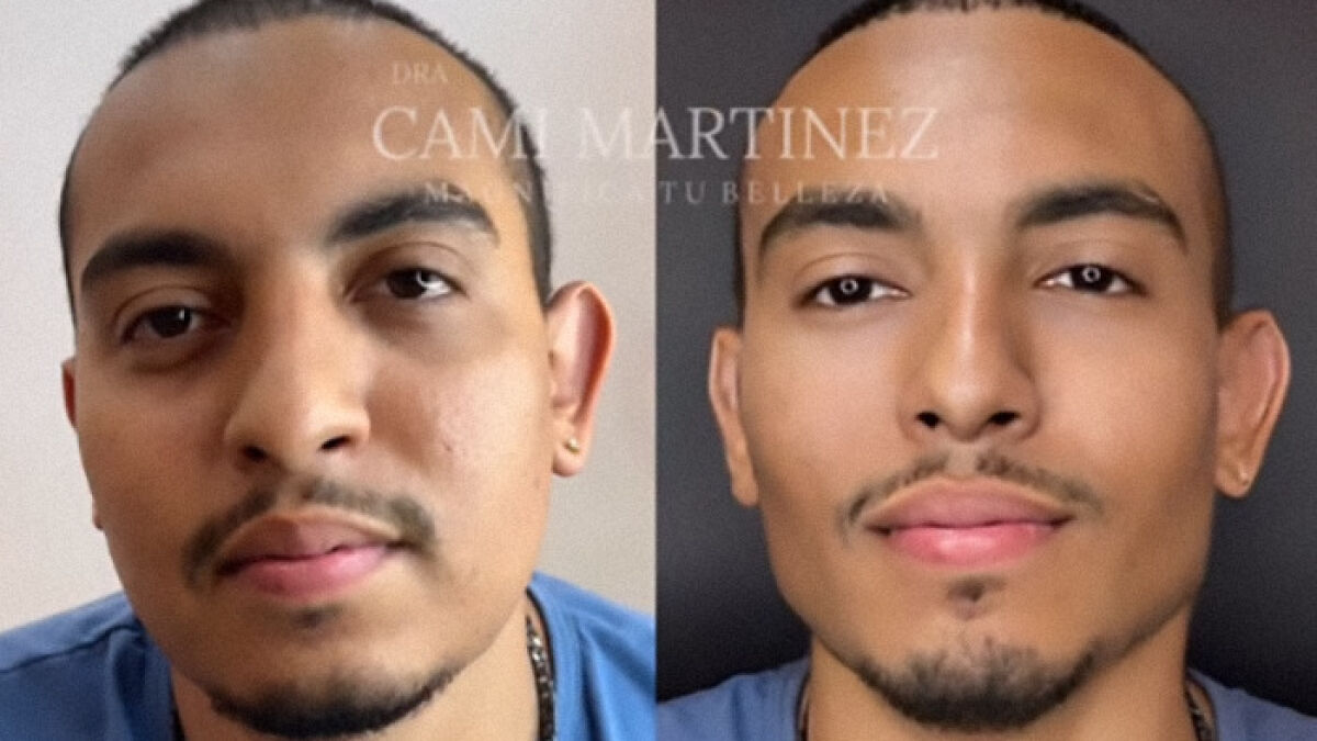“How Scary”: Patient’s Plastic Surgery Results That Took Decades Off His Appearance Go Viral