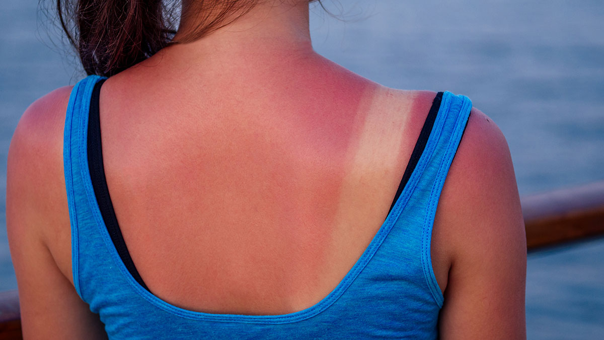 Dad Furious As Ex Lets Their Child Get Sunburned Over Her Partner’s Bizarre Sunscreen Conspiracy