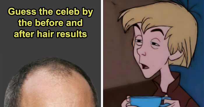 “Before And After Turkey”: 21 Upgraded Hairlines And You Need To Guess Who They Belong To
