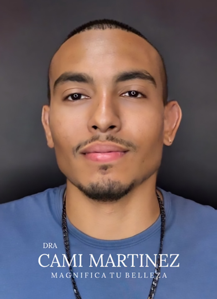 Man after plastic surgery, looking significantly younger, wearing a blue shirt against a dark background. Man after plastic surgery, looking significantly younger, wearing a blue shirt against a dark background.