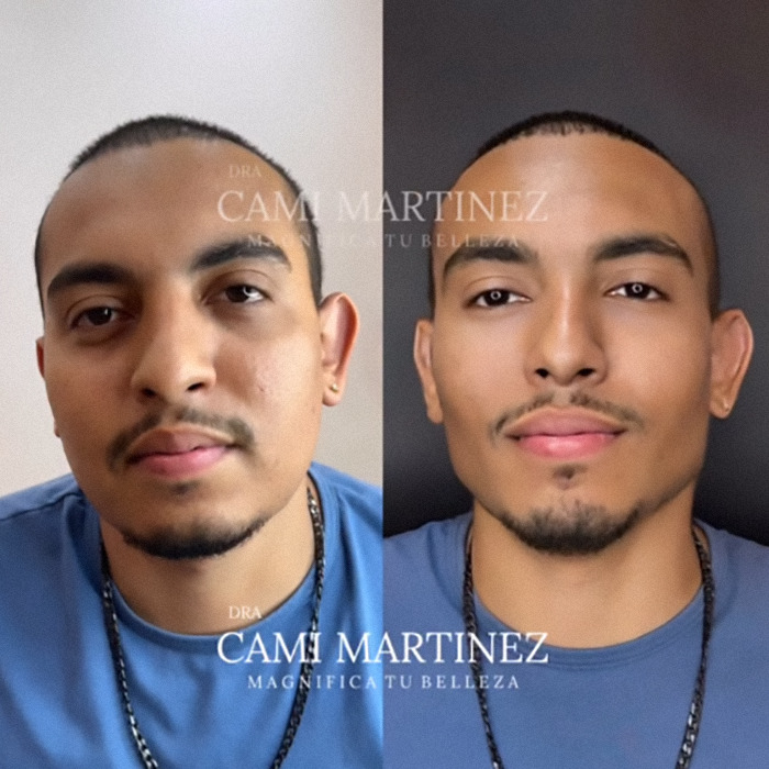 Man's plastic surgery transformation: side-by-side photo of before and after, showcasing a youthful change. Man's plastic surgery transformation: side-by-side photo of before and after, showcasing a youthful change.
