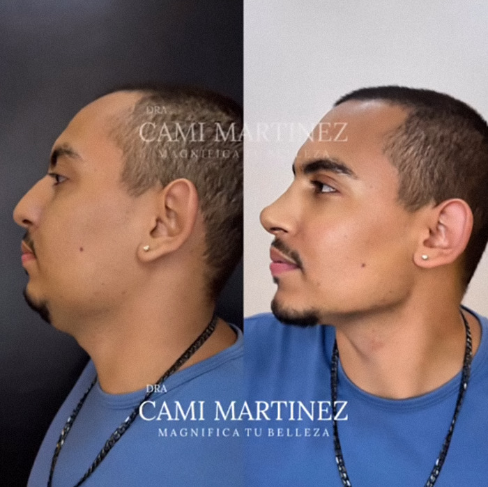 Man's plastic surgery transformation showing before and after side profiles, appearing much younger. Man's plastic surgery transformation showing before and after side profiles, appearing much younger.