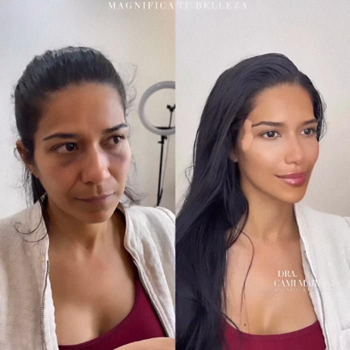 Plastic surgery transformation showcasing youthful makeover with before and after images. Plastic surgery transformation showcasing youthful makeover with before and after images.