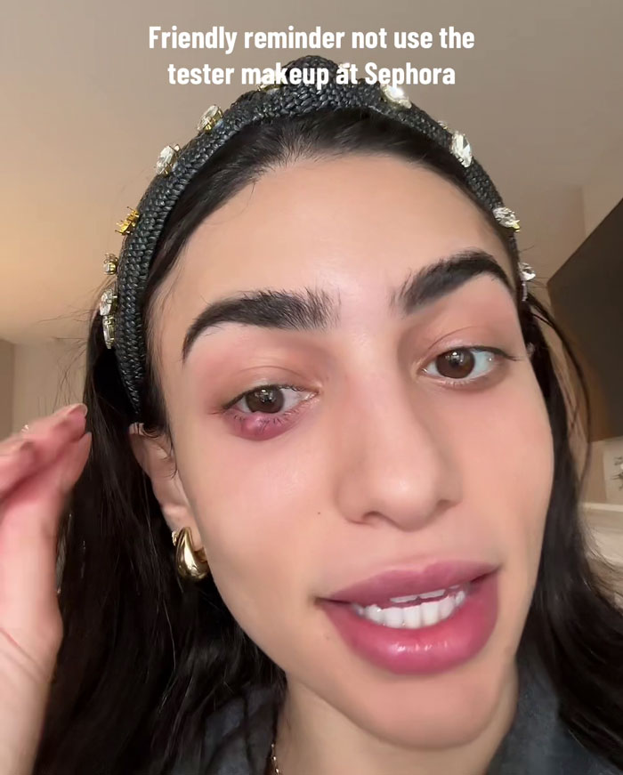 Woman with eye infection after using makeup testers at Sephora, sharing a cautionary tale. Woman with eye infection after using makeup testers at Sephora, sharing a cautionary tale.