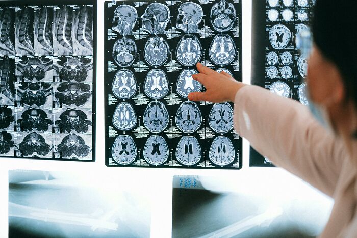 MRI brain scans being examined by a doctor, highlighting concerns about microplastics in our brains. MRI brain scans being examined by a doctor, highlighting concerns about microplastics in our brains.