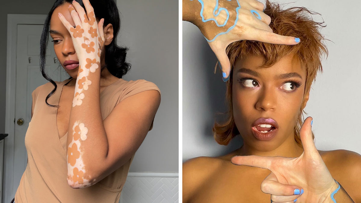 Dancer-Turned-Artist Amara Aleman Turns Her Vitiligo Into Vibrant Body Art (20 Pics)