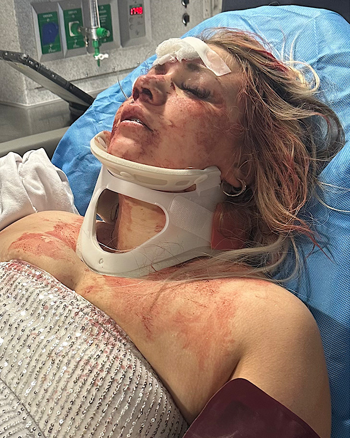 Injured bride-to-be at a hospital after shocking bachelorette party assault, wearing a neck brace and a bloodied dress. Injured bride-to-be at a hospital after shocking bachelorette party assault, wearing a neck brace and a bloodied dress.