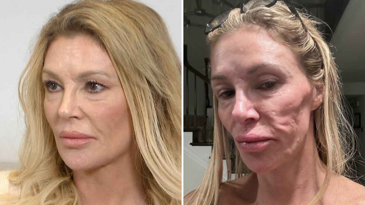 Brandi Glanville Says Her Face Has ‘Literally Melted Away’ Amid ‘Worse Than Ever’ Disfigurement