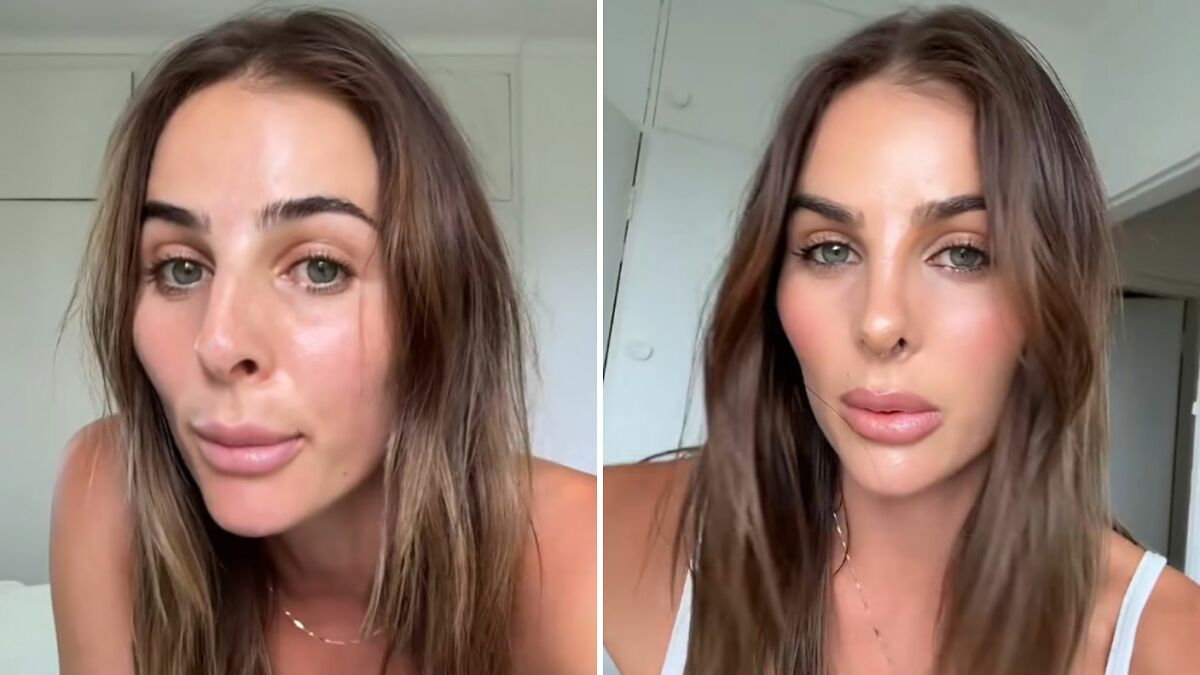 “See The Potential”: Woman Brutally Trolled After Rhinoplasty Defends The Results