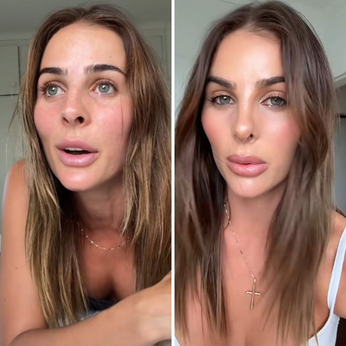 Woman defends rhinoplasty results, showcasing before and after photos. Woman defends rhinoplasty results, showcasing before and after photos.