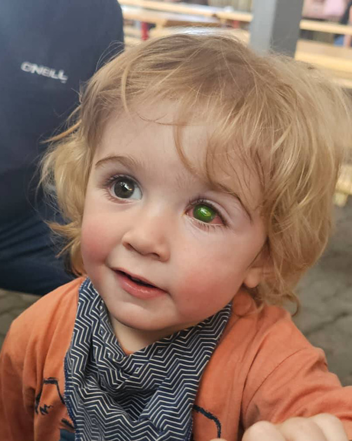 Toddler with eye issue related to herpes virus, wearing an orange shirt and patterned bib indoors. Toddler with eye issue related to herpes virus, wearing an orange shirt and patterned bib indoors.