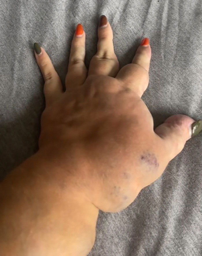 Woman's hand with one arm visibly larger, showcasing beauty in uniqueness. Woman's hand with one arm visibly larger, showcasing beauty in uniqueness.