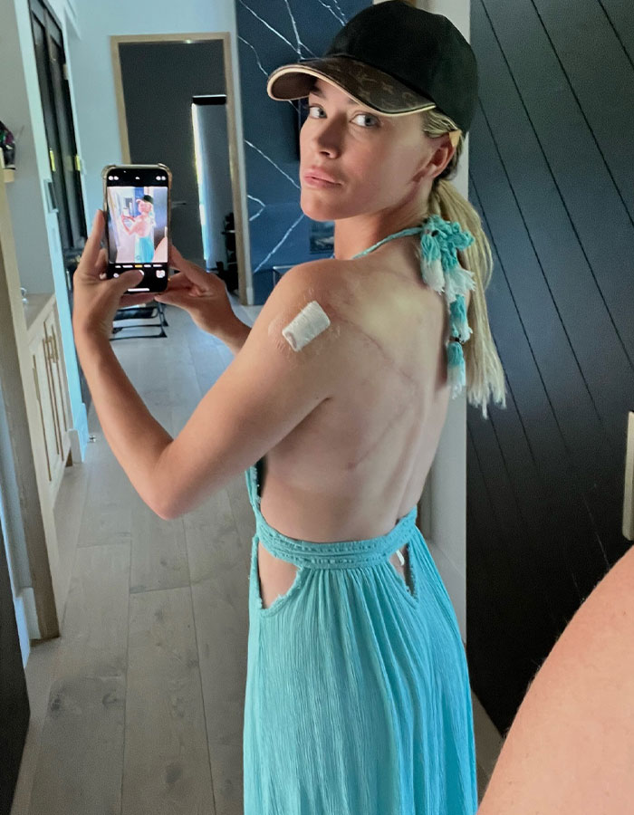 Woman in a turquoise dress, taking a mirror selfie, showing a bandage on her shoulder, related to ongoing cancer battle. Woman in a turquoise dress, taking a mirror selfie, showing a bandage on her shoulder, related to ongoing cancer battle.