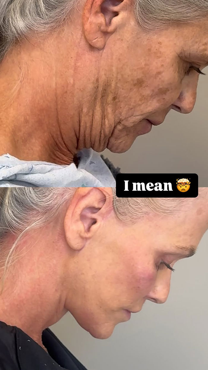 66-year-old's impressive plastic surgery transformation, before and after side profile. 66-year-old's impressive plastic surgery transformation, before and after side profile.