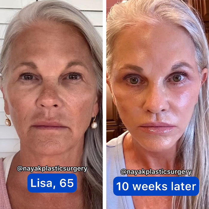 65-year-old woman before and after successful plastic surgery transformation. 65-year-old woman before and after successful plastic surgery transformation.