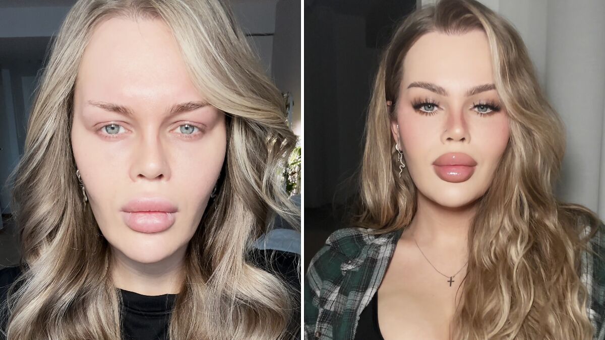 “Now Fix Your Bottom Lip”: YouTube Influencer Reveals Gory Eyelid Surgery Aftermath In New Video