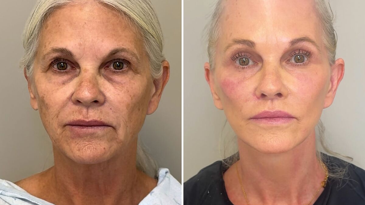 “Phenomenal Results”: 66-Year-Old Woman Undergoes 9 Surgeries In 6 Hours, Breaks The Internet