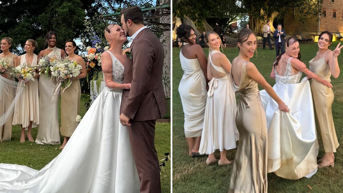 Miracle Burns Survivor Dubbed “Australia’s Bravest Girl” Ties The Knot In Heartwarming Ceremony