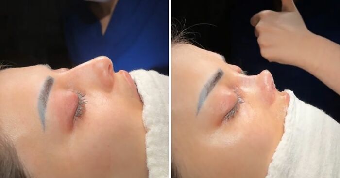 “She Had The Perfect Nose”: Botched Nose Job Video Goes Viral