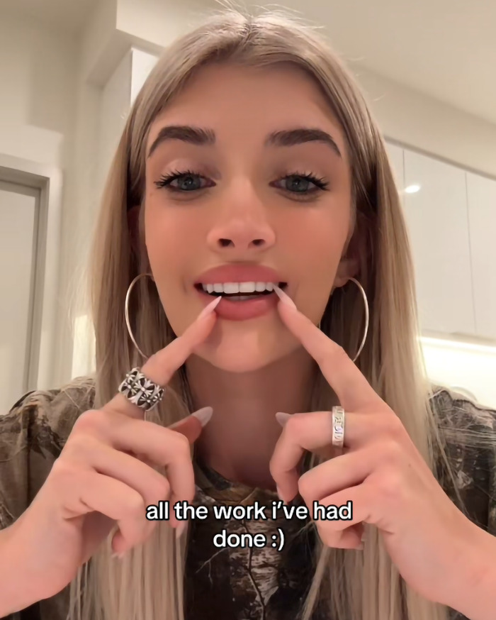 Young woman gesturing to her teeth, discussing her cosmetic surgeries in a kitchen setting. Young woman gesturing to her teeth, discussing her cosmetic surgeries in a kitchen setting.