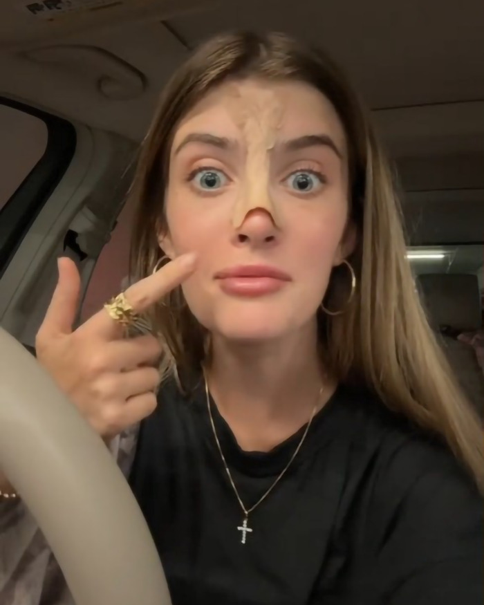 Young woman pointing at her nose in a car, highlighting cosmetic surgery changes. Young woman pointing at her nose in a car, highlighting cosmetic surgery changes.