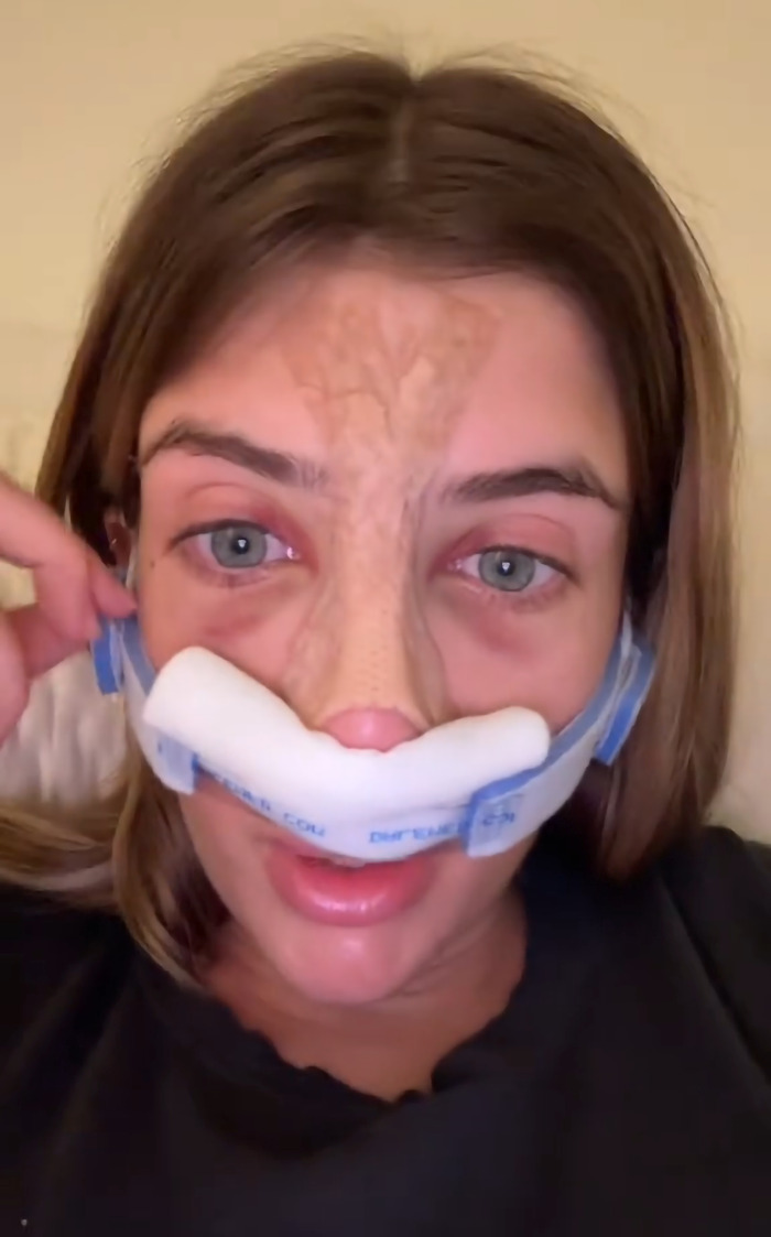 Young woman recovering from cosmetic surgery, wearing a nasal bandage and a black shirt, resting on a beige pillow. Young woman recovering from cosmetic surgery, wearing a nasal bandage and a black shirt, resting on a beige pillow.