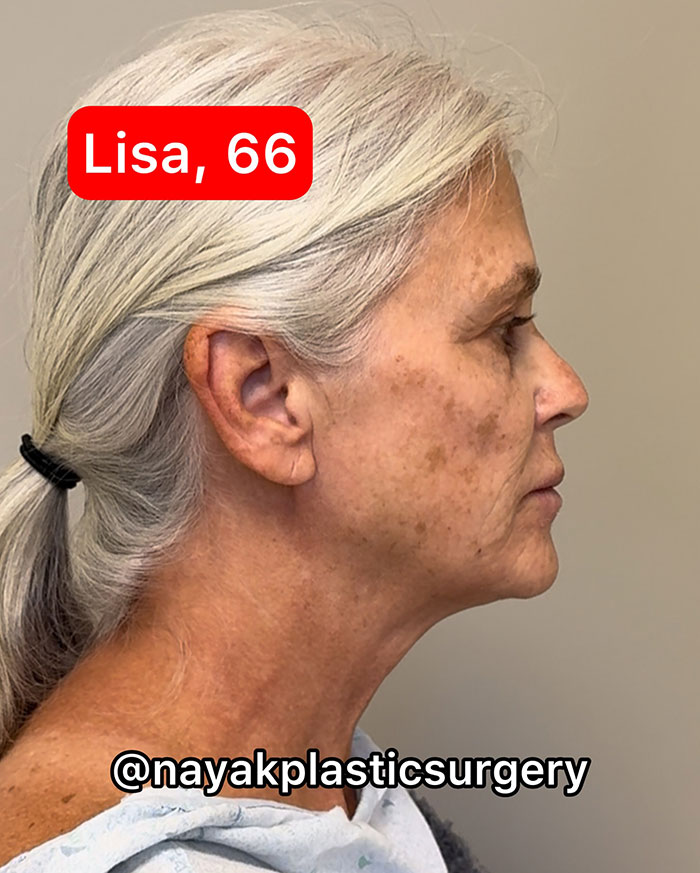 66-year-old woman before undergoing 9 cosmetic procedures in one session, side profile view. 66-year-old woman before undergoing 9 cosmetic procedures in one session, side profile view.