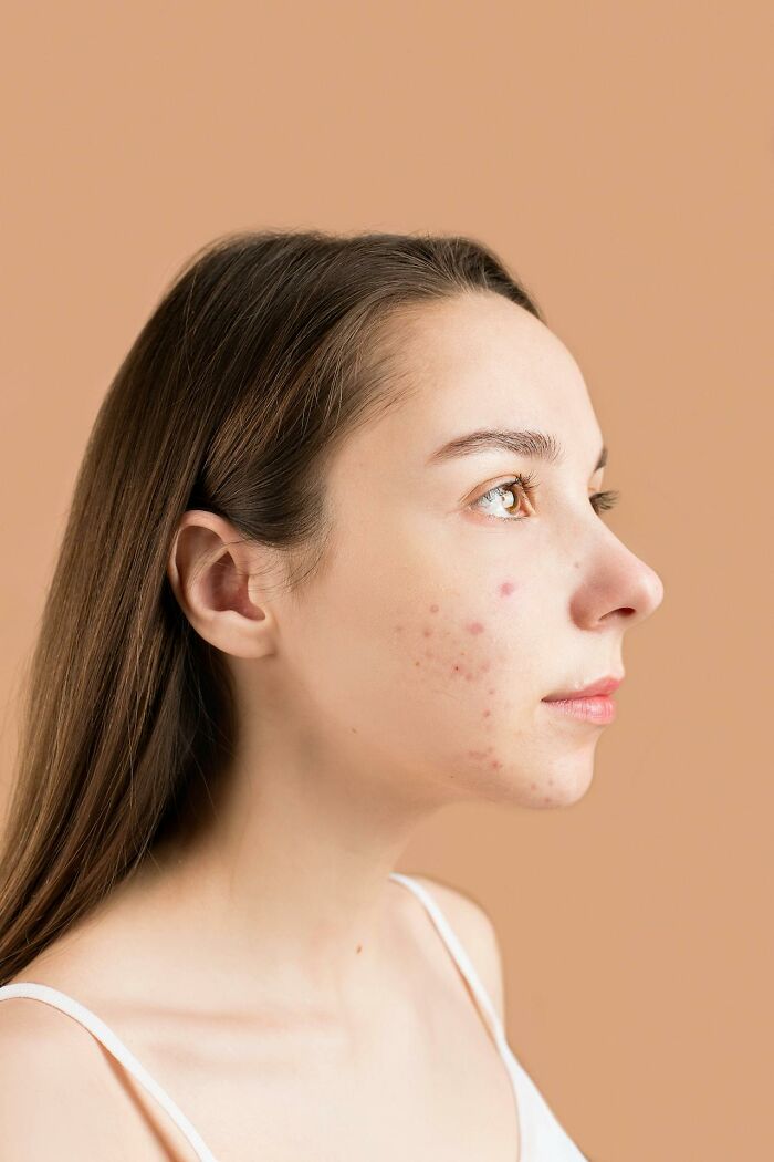 Woman with acne, side profile against a beige background, addressing common female insecurities.
