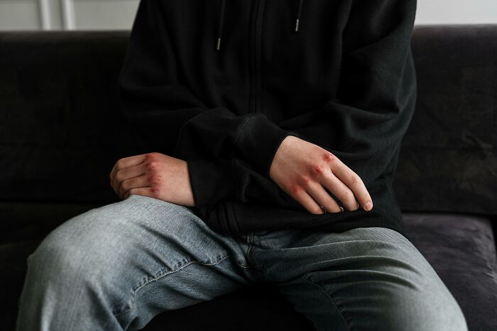 Person in hoodie with bruised hands sitting on a couch, symbolizing bully consequences.
