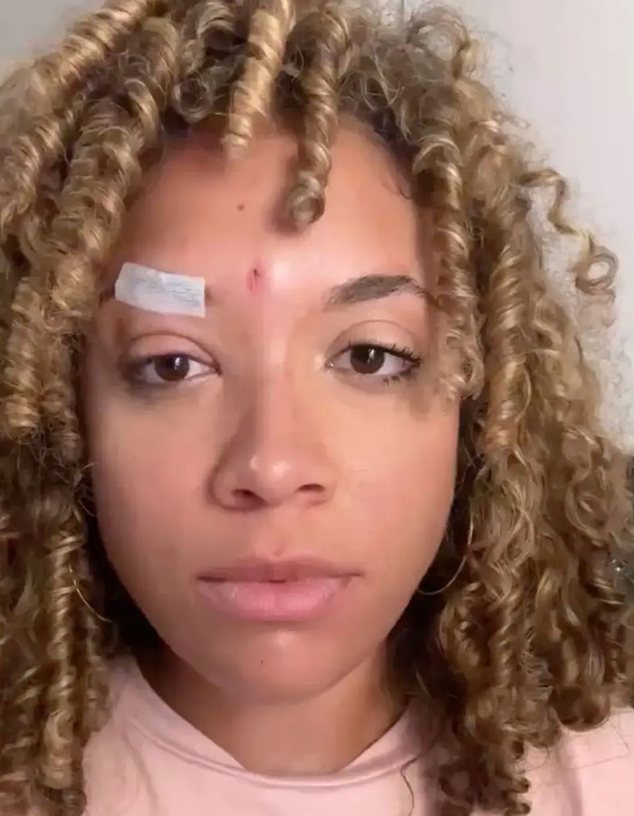 Pro-life activist with bandage on forehead, visible injury after street interview. Pro-life activist with bandage on forehead, visible injury after street interview.