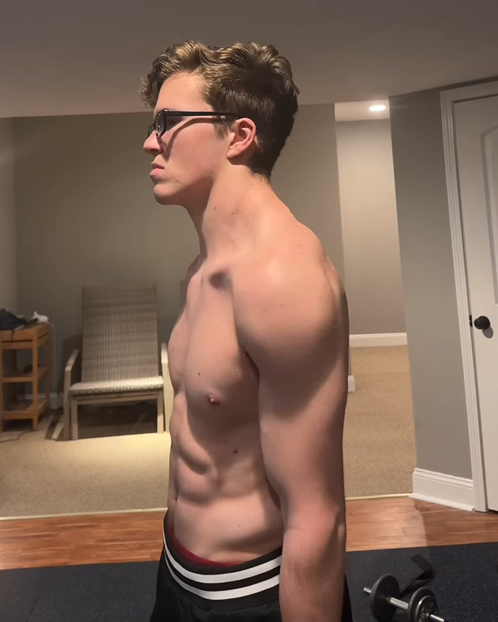19-year-old "The Crooked Man" showing imbalance from working out one side of his body; wearing glasses in a gym setting. 19-year-old "The Crooked Man" showing imbalance from working out one side of his body; wearing glasses in a gym setting.