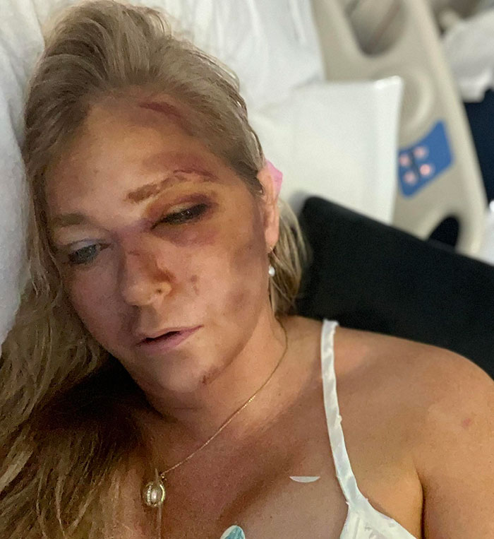 Injured woman lying in hospital bed with bruises and swelling, highlighting Virginia Giuffre lawyer doubts claim. Injured woman lying in hospital bed with bruises and swelling, highlighting Virginia Giuffre lawyer doubts claim.