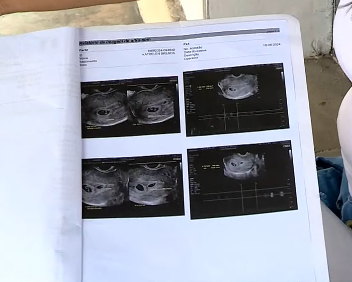 Ultrasound scans held by a pregnant woman expecting twins, showing different views. Ultrasound scans held by a pregnant woman expecting twins, showing different views.