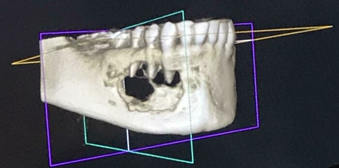 3D scan of a human jawbone with missing teeth showing bizarre and fascinating details of the human body. 3D scan of a human jawbone with missing teeth showing bizarre and fascinating details of the human body.