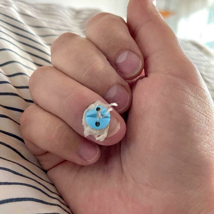 Close-up of a human finger with a blue button attached using tissue, illustrating a bizarre photo of the human body. Close-up of a human finger with a blue button attached using tissue, illustrating a bizarre photo of the human body.