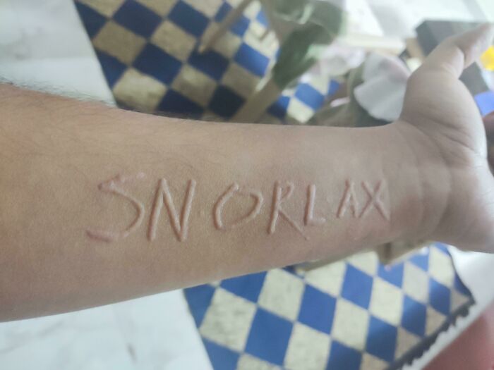 Close-up of a human arm with raised scars forming the word SNORLAX, showcasing bizarre human body markings. Close-up of a human arm with raised scars forming the word SNORLAX, showcasing bizarre human body markings.