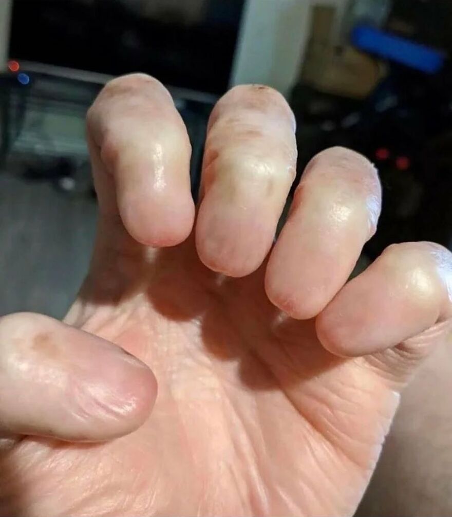 Close-up of fingers with unusual nail formation showing bizarre medical condition on a human hand.