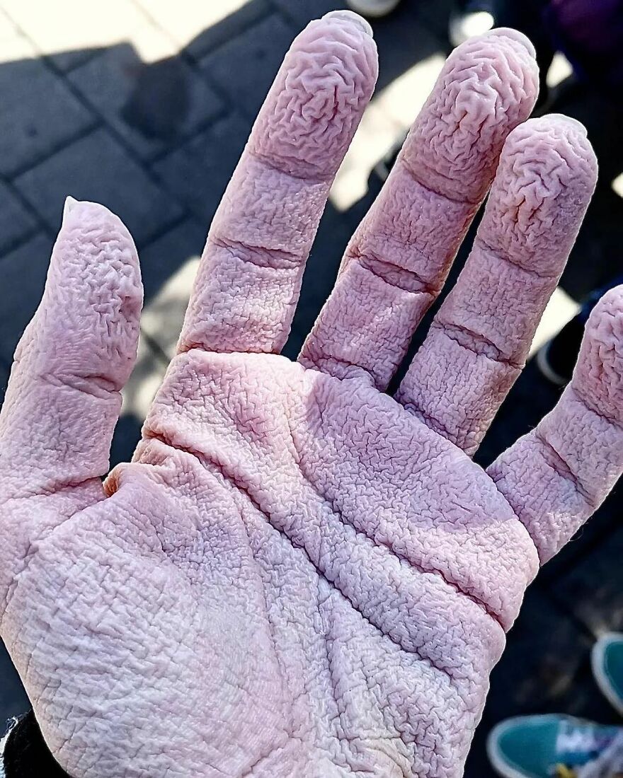 Close-up of a hand with bizarre, wrinkled skin texture showing an eerie medical condition.