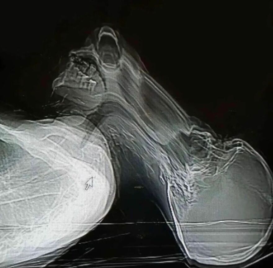 X-ray image showing a blurred double exposure of a human skull and neck with eerie distortion effects.