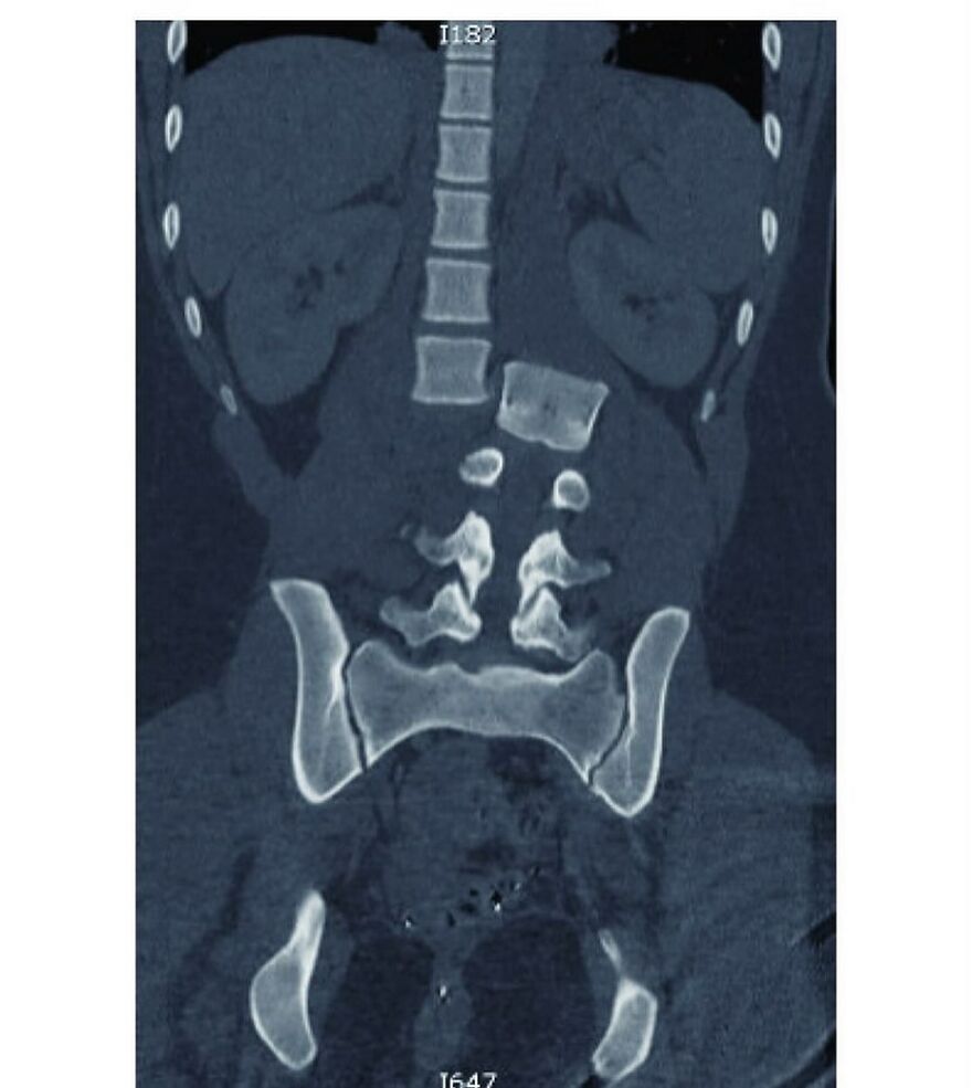 CT scan image showing bizarre medical condition with spinal and pelvic bone abnormalities from eerie medical pics collection.