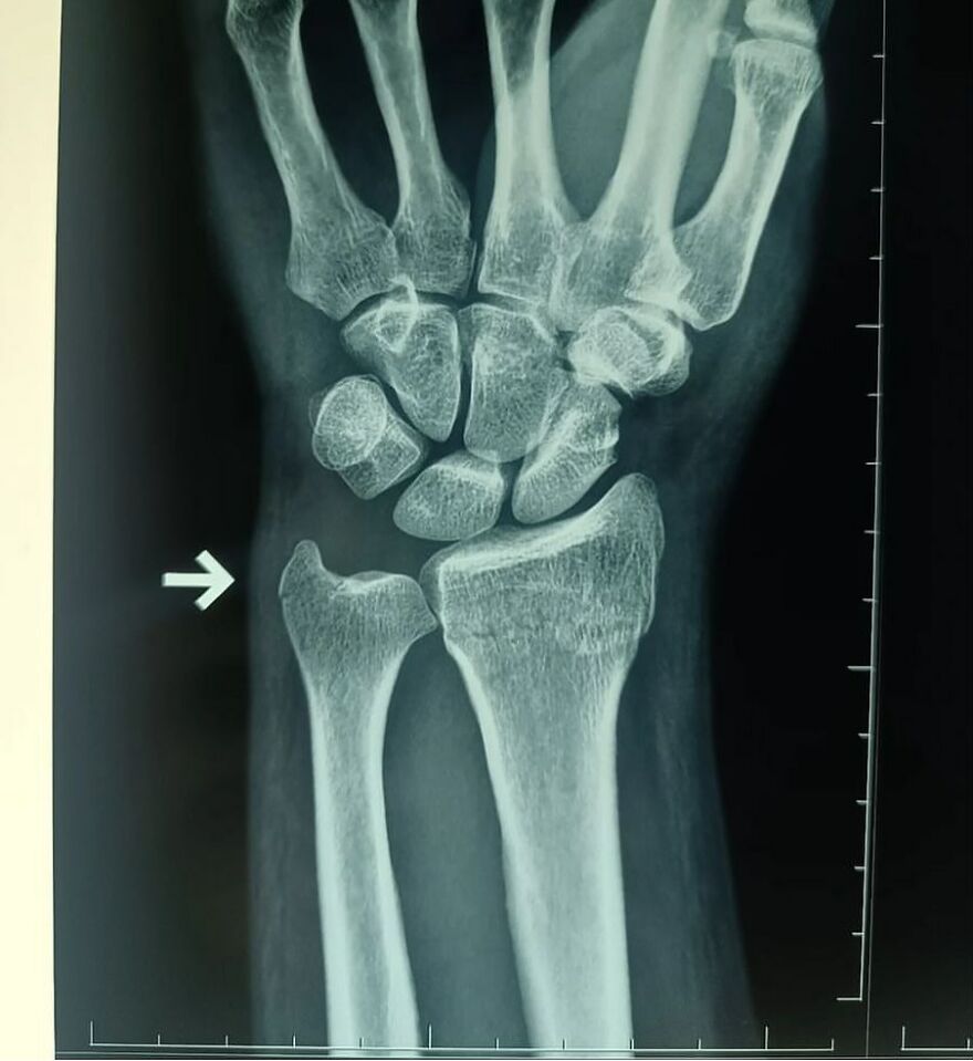 X-ray image of a wrist with a visible bone fracture shared on an IG account featuring bizarre medical pics