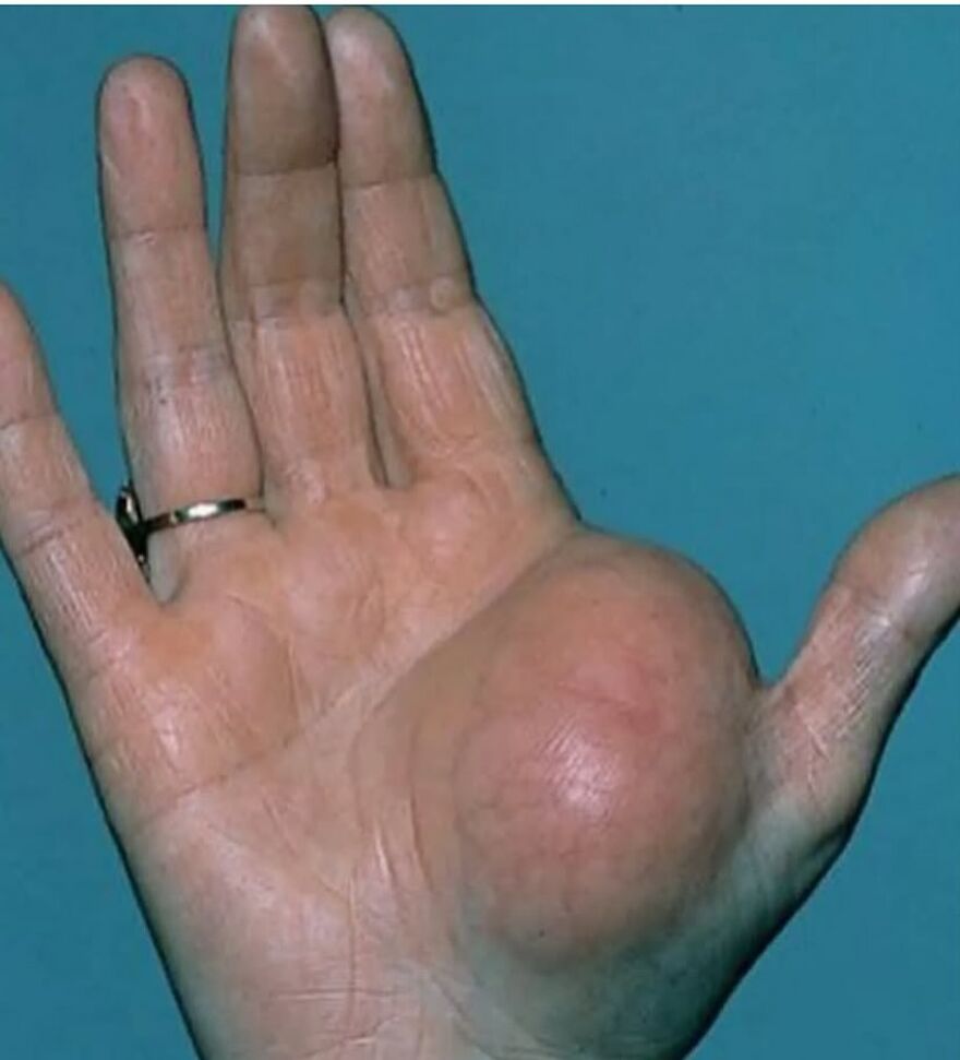 Close-up of hand with a large, unusual swelling on the palm, featured in bizarre medical pics collection.